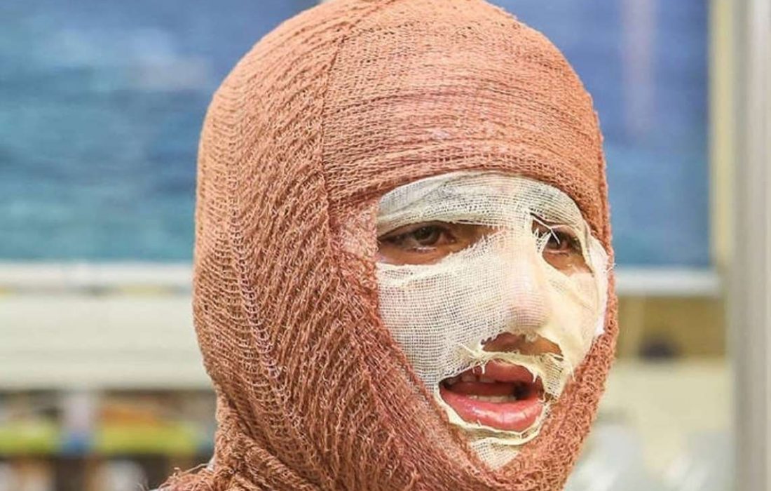 بروز ۹۱ مورد سوختگی افراد در حوادث سال جاریِ شهرستان کاشان