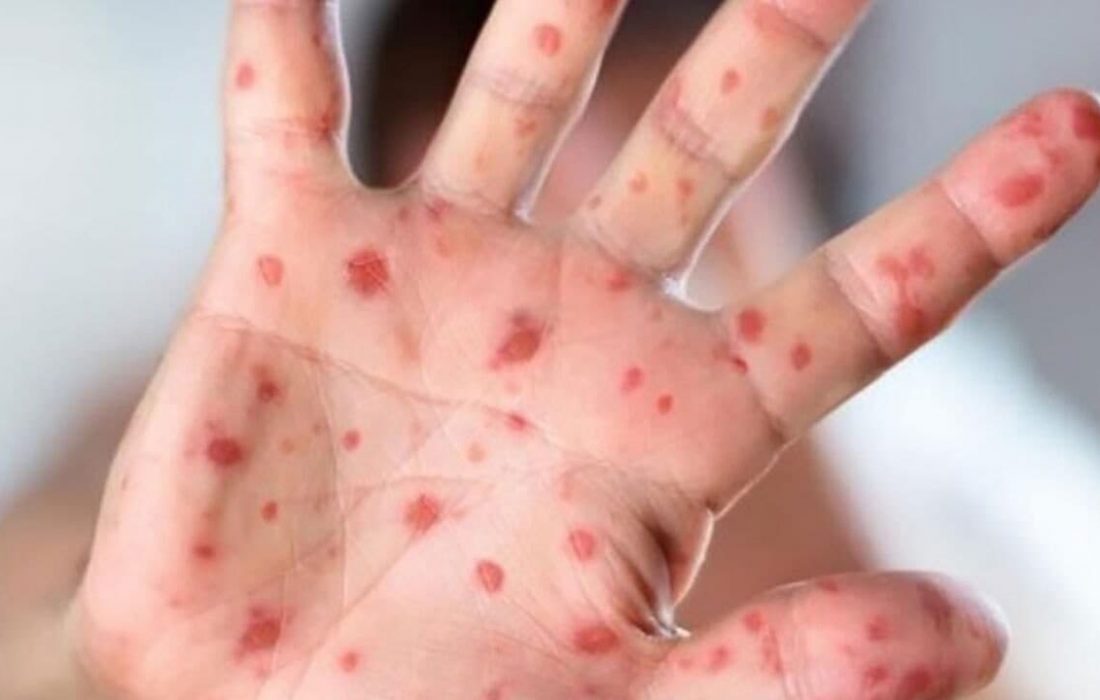 شناسایی سه مورد بیماری سرخک در منطقه کاشان